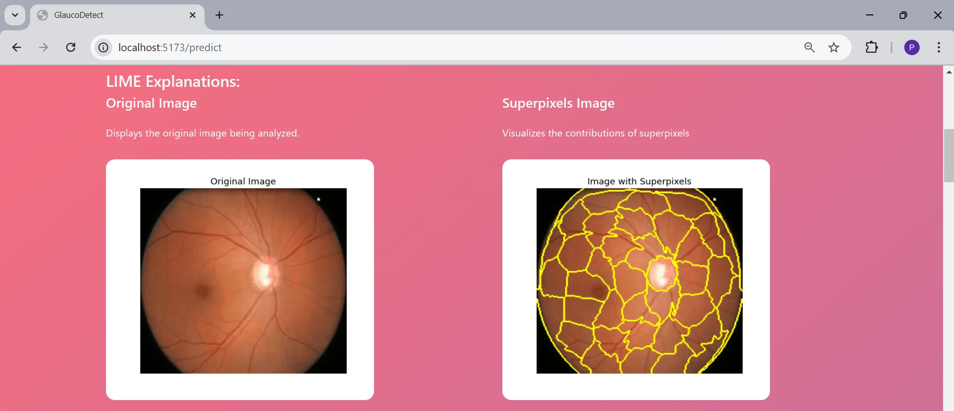 Explainable AI-Based Glaucoma Detection preview 3 of 6